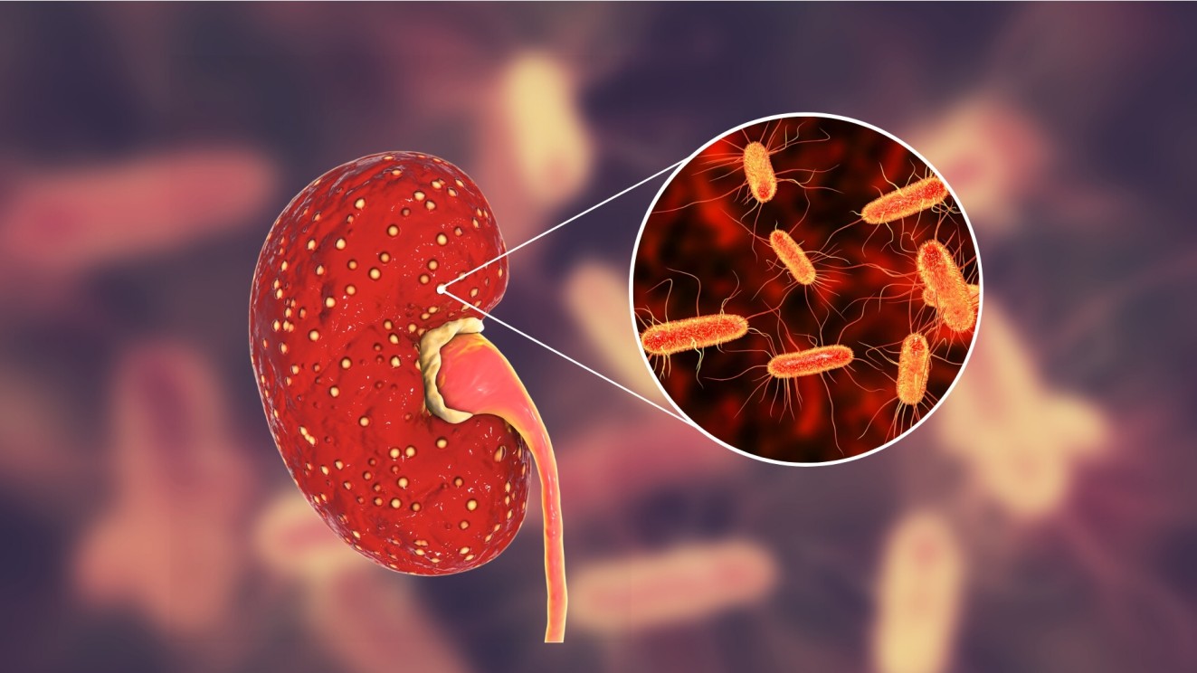 Pyelonephritis (Kidney Infection), Types (Acute Pyelonephritis &Chronic Pyelonephritis), Causes, Symptomsï¿½